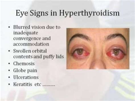 In most cases, patients feel much better as early as 72 hours after parathyroid surgery. . Hyperparathyroidism eye problems